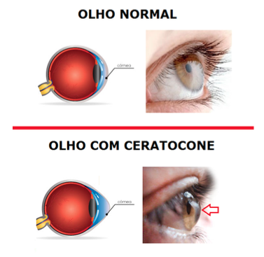 Ceratocone - Oftalmologista em Natal RN Pedro Paulo Cabral